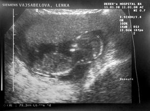 Dnes je 11.1.2006 a ja mam 14 tyzdnov a 8 cm :-) Pre tych ktori zacali pocitat, nemuseli sme sa brat, prosto mam sikovneho mazela a otehotnela som v oktobri 2005 :-o Boli sme dost prekvapeni, ze tak skoro, necakala som to...mesiac po svadbe. Ale vset